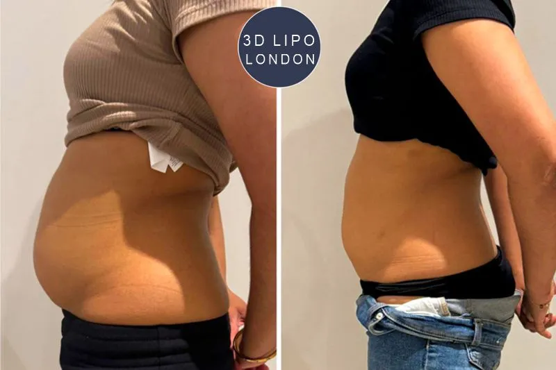 Abdomen fat reduction results