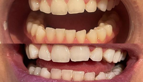 Teeth whitening before and after results showing 8 shades lighter transformation at our London clinic